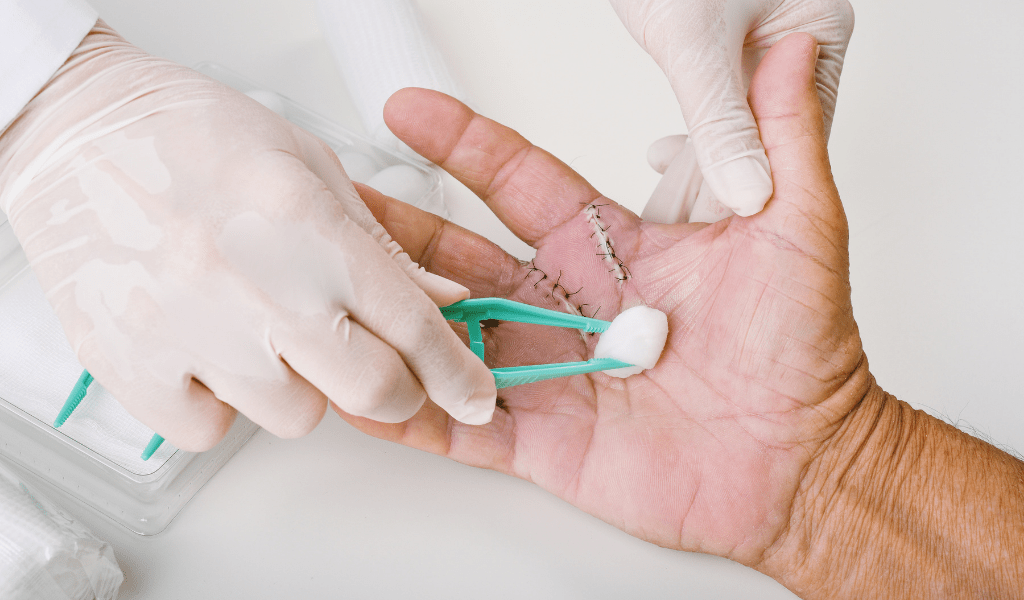 بخیه و سوچور در خانه