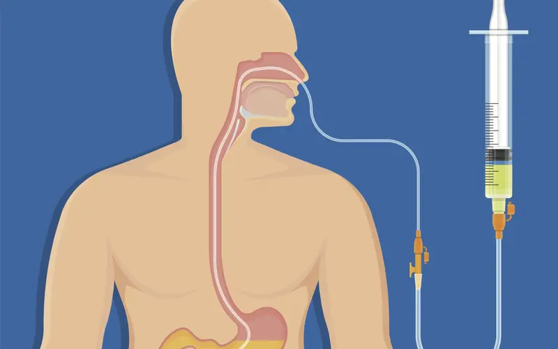 لوله تغذیه به معده