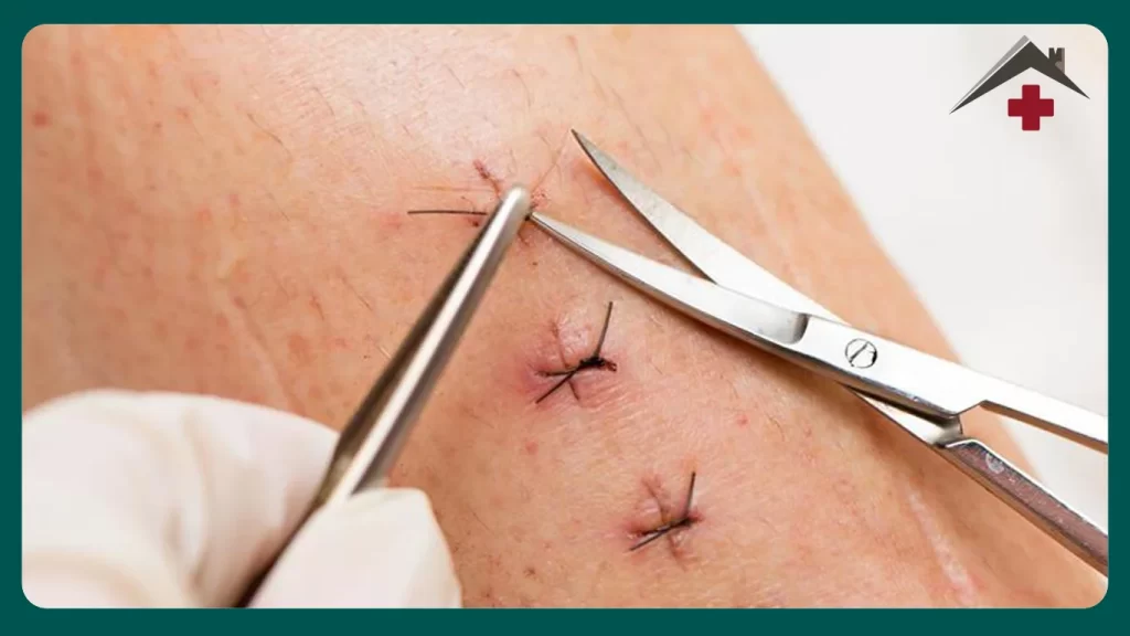 کشیدن بخیه در منزل