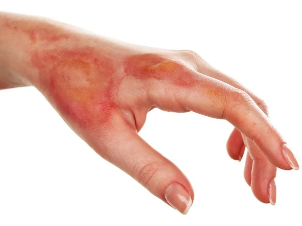 درمان سوختگی در منزل