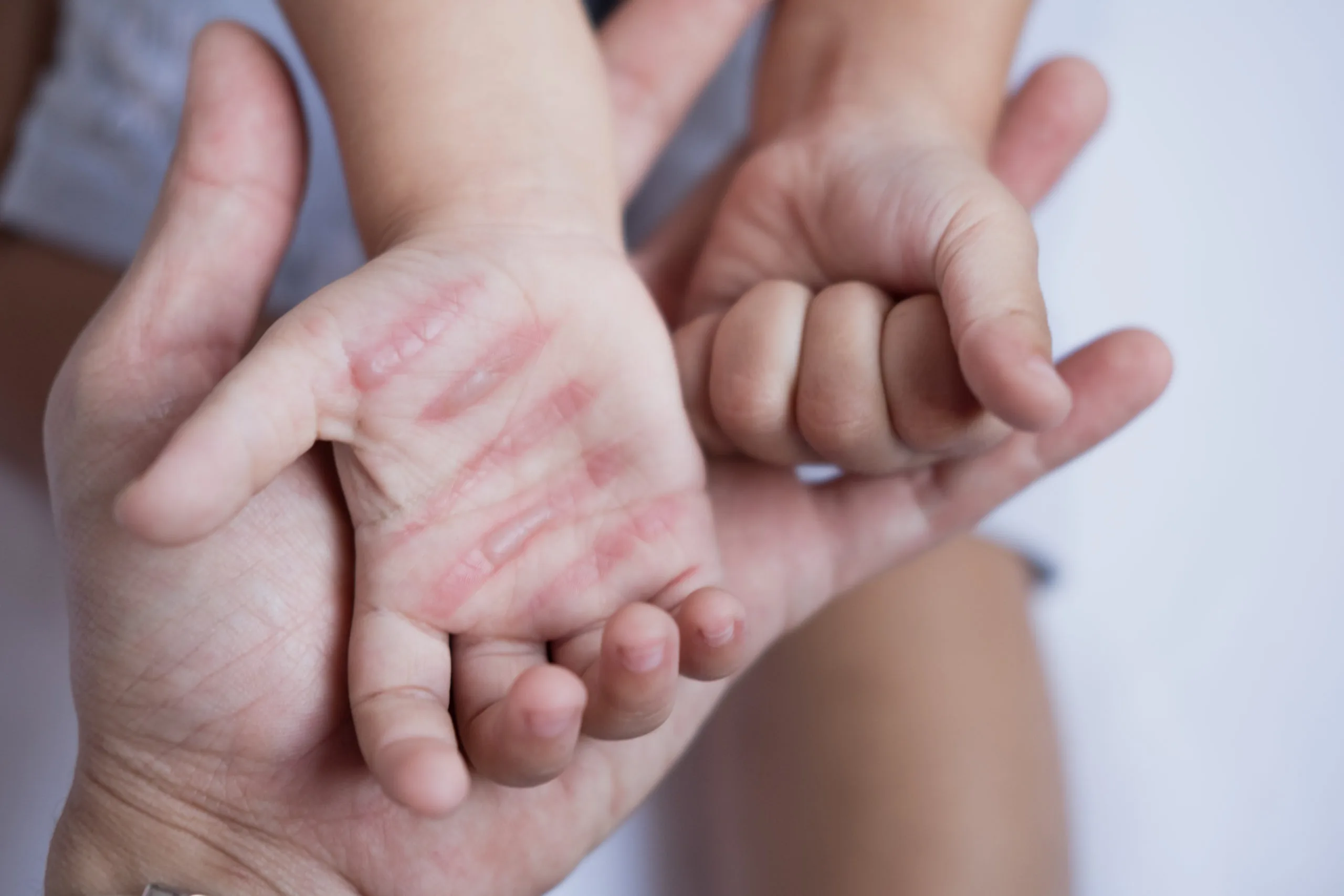 مراحل ترمیم زخم سوختگی