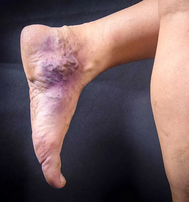 درمان زخم در منزل